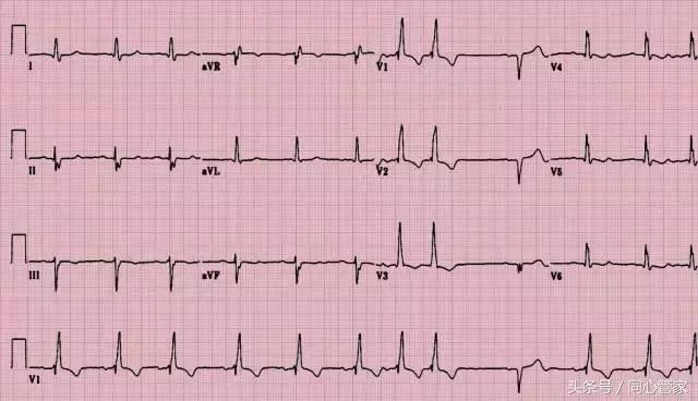 做完支架以后首次复查有哪些项目,颈动脉放支架一年后复查哪些项目