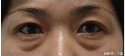 鱼尾纹眼袋克星,中药去鱼尾纹和眼袋