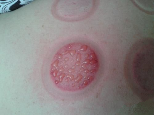 怎么通过拔罐的颜色判断身体状况,肩膀拔罐后颜色黑紫是怎么回事