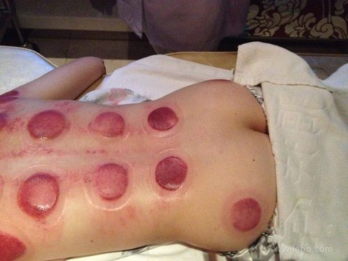 怎么通过拔罐的颜色判断身体状况,肩膀拔罐后颜色黑紫是怎么回事