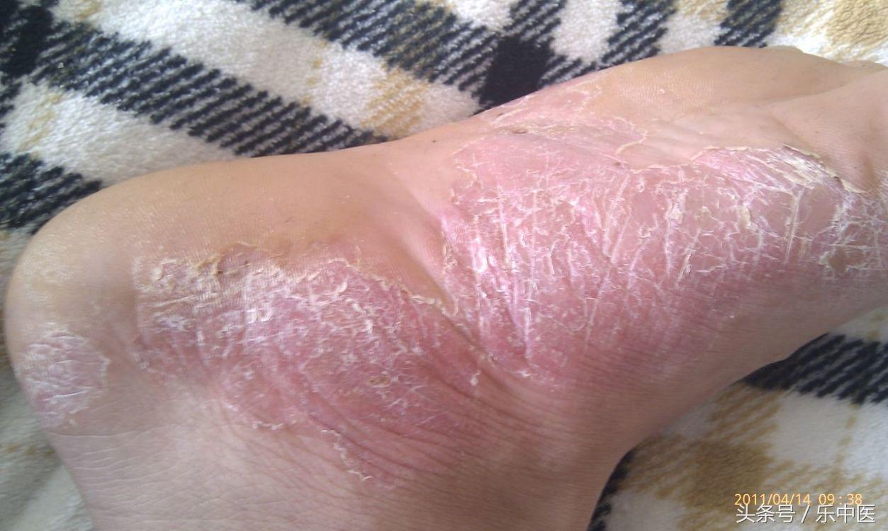 得了脚气需要忌口吗,得了脚气很烦人记住这两步帮到你