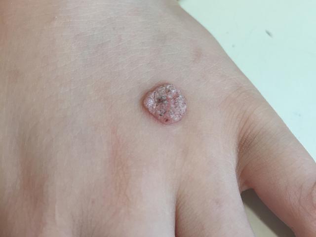 瘊子有传染性，用手乱抓乱抠，结果瘊子可能会越来越多