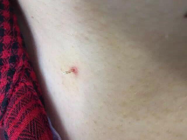 瘊子有传染性，用手乱抓乱抠，结果瘊子可能会越来越多