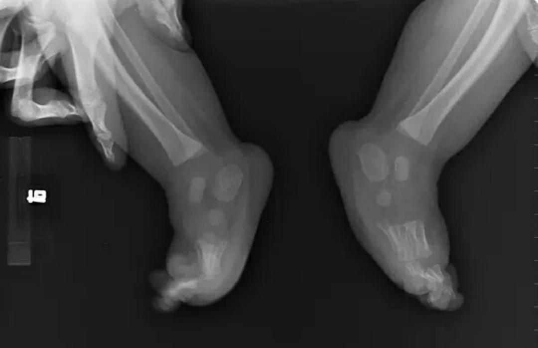 先天性马蹄足内翻可以治愈吗,马蹄足和足内翻是一样的吗