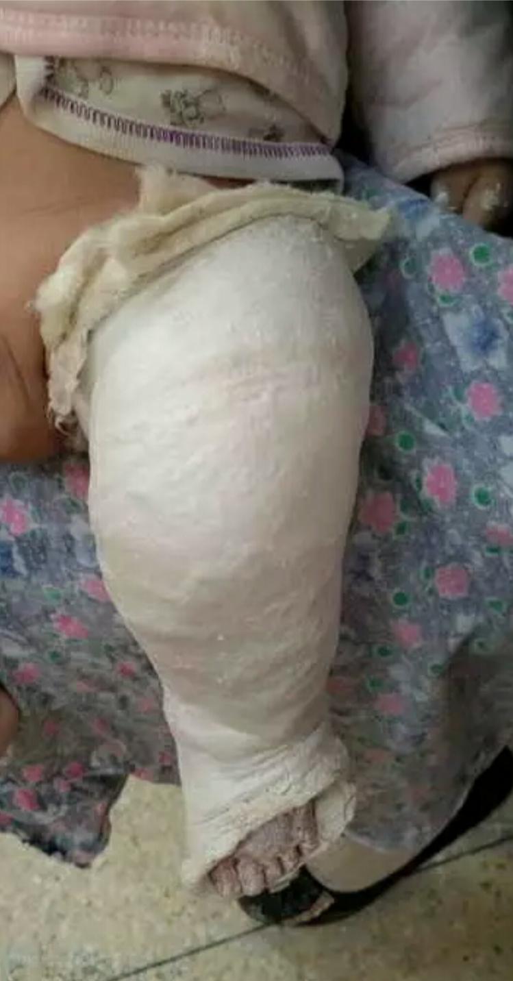 先天性马蹄足内翻可以治愈吗,马蹄足和足内翻是一样的吗