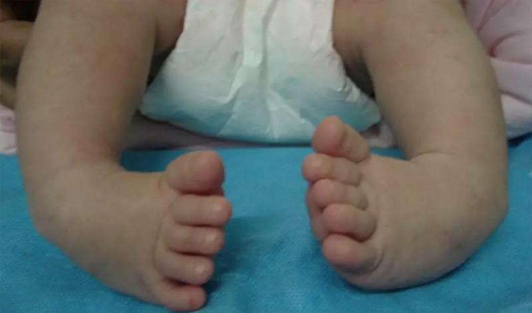 先天性马蹄足内翻可以治愈吗,马蹄足和足内翻是一样的吗