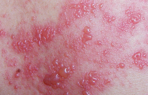 黄煌教授治疗带状疱疹的方法,李铁红治病视频