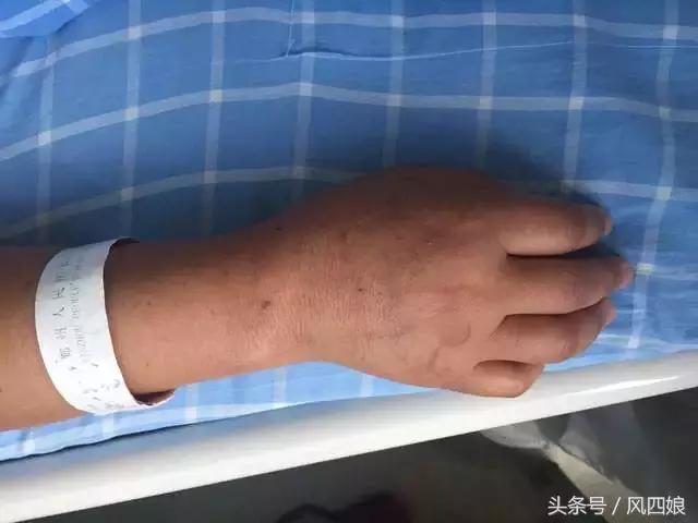 留置针打手背容易鼓包,打留置针后手臂疼怎么办