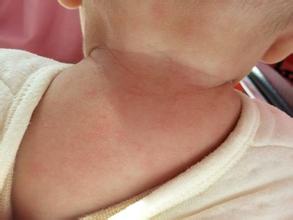 幼儿急疹出疹子期间注意事项,发烧以后出疹子需要注意什么