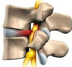 如何治疗腰椎管狭窄效果最好,腰椎管狭窄膨出怎么治疗最好