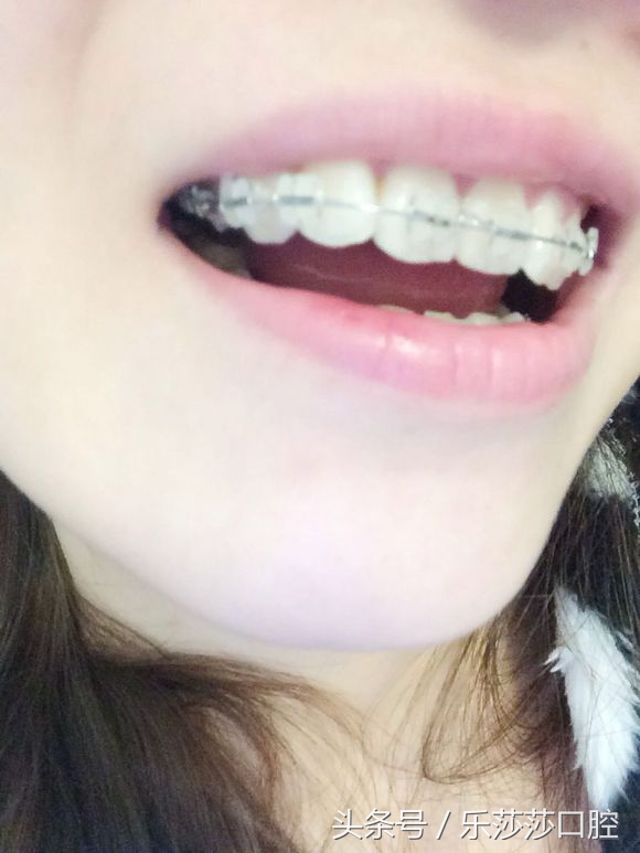 箍牙功效与作用,箍牙全过程真实