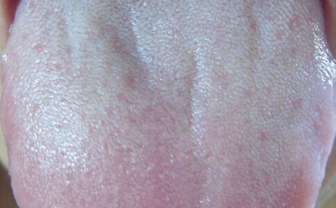 每天大便正常但舌苔厚白,婴儿舌苔厚白正常吗