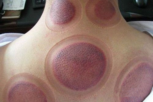 怎么通过拔罐的颜色判断身体状况,肩膀拔罐后颜色黑紫是怎么回事