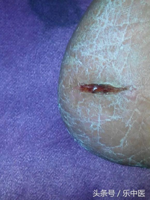 得了脚气需要忌口吗,得了脚气很烦人记住这两步帮到你