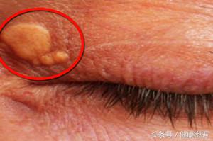 眼睛有红血丝和黄色斑块怎么消除,眼睛周围有黄色斑块怎么回事