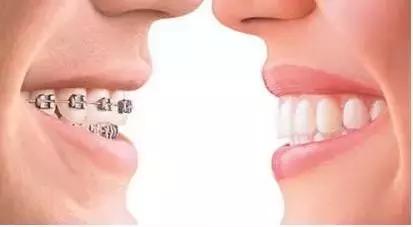 正畸到什么程度才会用皮筋,正畸什么阶段会变美