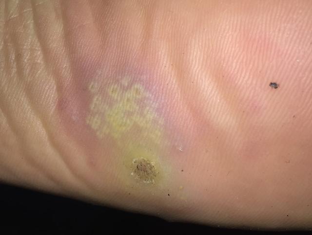 瘊子有传染性，用手乱抓乱抠，结果瘊子可能会越来越多