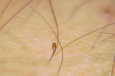 小孩头上长虱子卵怎么弄掉,农村小孩头上的虱子