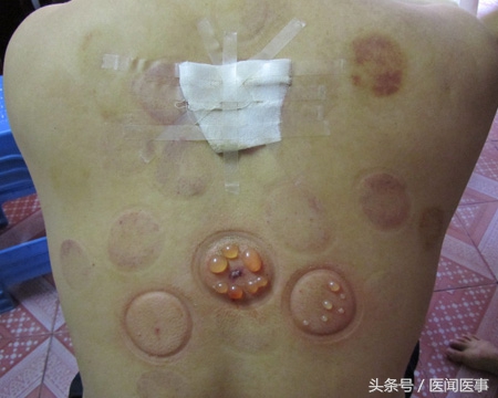 拔火罐拔出来的水泡真的是湿气吗,拔火罐拔出的湿气是肉湿还是外湿
