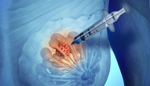 乳腺癌内分泌治疗的耐药基因 (乳腺癌内分泌治疗多久会出现耐药)