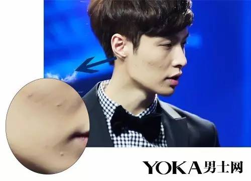 赵丽颖黑头怎么去掉,赵丽颖黑头去除方法