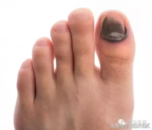 解决灰指甲,怎样根治灰指甲