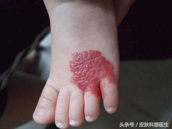 宝宝身上长了血管瘤要怎么治疗,肝上长血管瘤0.7x0.8要不要治疗