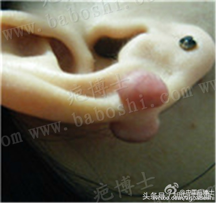 疤痕贴为什么价格悬殊这么大,疤痕一般什么价格