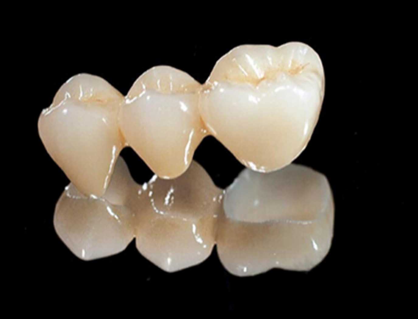 烤瓷牙怎么防止变色,烤瓷牙会变形吗