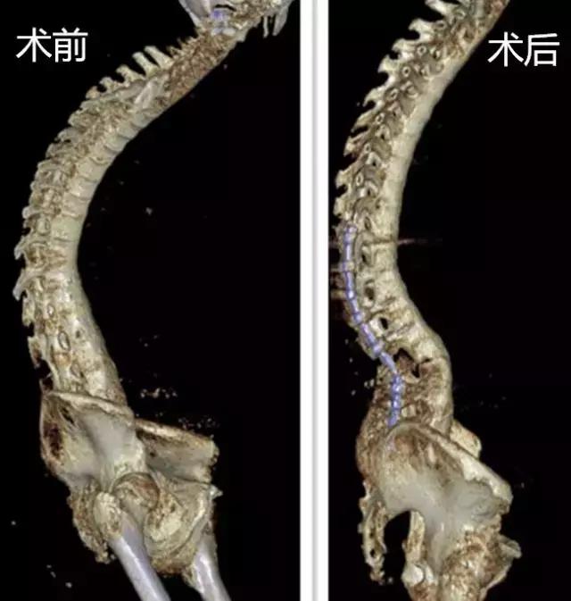40岁壮汉背弯得像只虾，看看医生是怎么将他“拉直”的