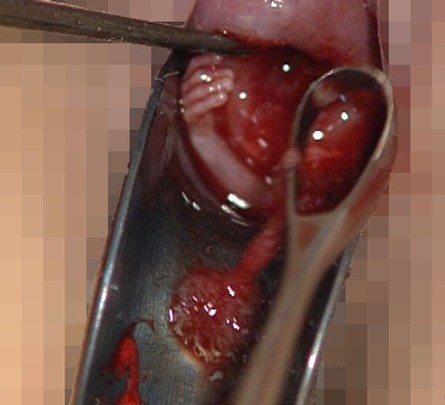 人工流产最好的方式,人工流产哪种方式最安全