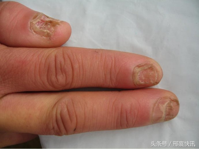 小孩灰指甲初期症状,手上有灰指甲的症状
