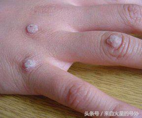 避免寻常疣上身的生活小秘诀