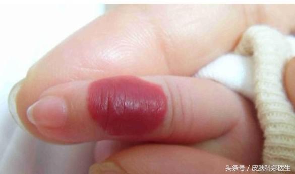 宝宝身上长了血管瘤要怎么治疗,肝上长血管瘤0.7x0.8要不要治疗