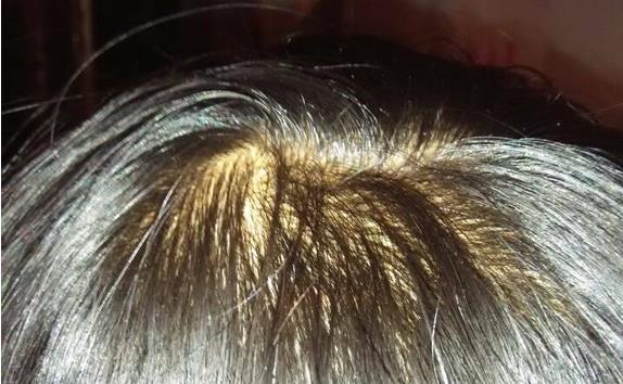 头皮发黄、发红、头屑多、脱发？这是头皮的求救信号！