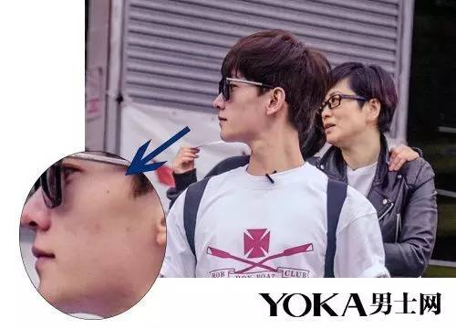 赵丽颖黑头怎么去掉,赵丽颖黑头去除方法