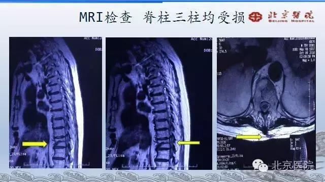 北京腰椎骨折微创手术,北京骨科大腿骨头骨折手术