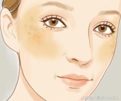 褐青色斑有哪些方法可以去除,消除褐斑的方法