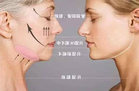 线雕对抗面部衰老的秘密,线雕抗衰依靠三方面的力量