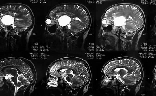 海绵窦海绵状血管瘤,海绵窦区海绵状血管瘤发病年龄