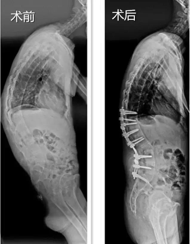40岁壮汉背弯得像只虾，看看医生是怎么将他“拉直”的
