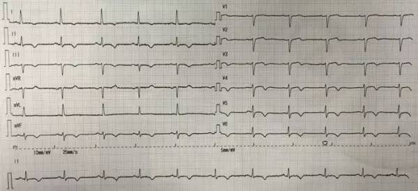 车祸后左胸下方隐隐作痛怎么回事,车祸后胸痛是怎么回事