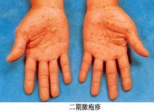 手指上起红色小红点是湿疹吗,手湿疹疹子变成深红色