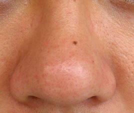 男生鼻子毛孔粗大有油脂黑头,毛孔粗大堵塞黑头闭口