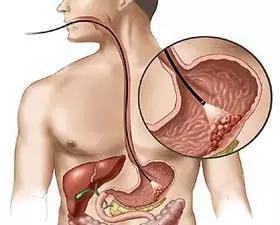 名家专栏︳“酸”相关疾病，不注意说不定你就是下一个患者