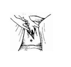 产后妈妈侧切后的护理,产后侧切缝合线多久吸收