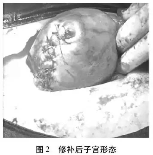 输卵管切除并发症,输卵管妊娠手术风险