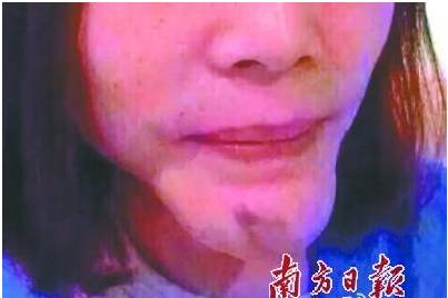 女性祛痘痘被毁容,打水光针毁容的视频