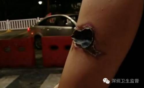 洗纹身感染出脓溃烂会不会留疤,洗纹身伤口发炎溃烂多久不疼