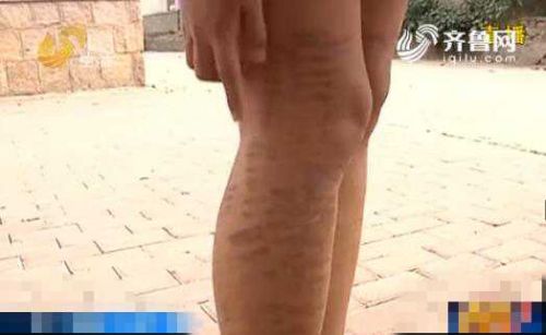 青岛女子做激光脱毛变“斑马腿”大片红肿还起泡